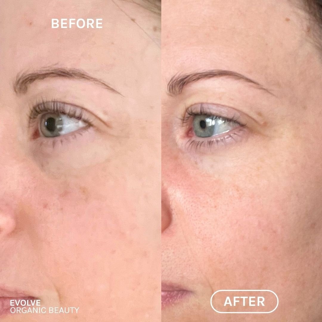 R+N Serum Before & After Main